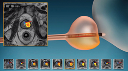 Ultrazëri shkatërron 80 për qind të kancerit të prostatës në një studim njëvjeçar