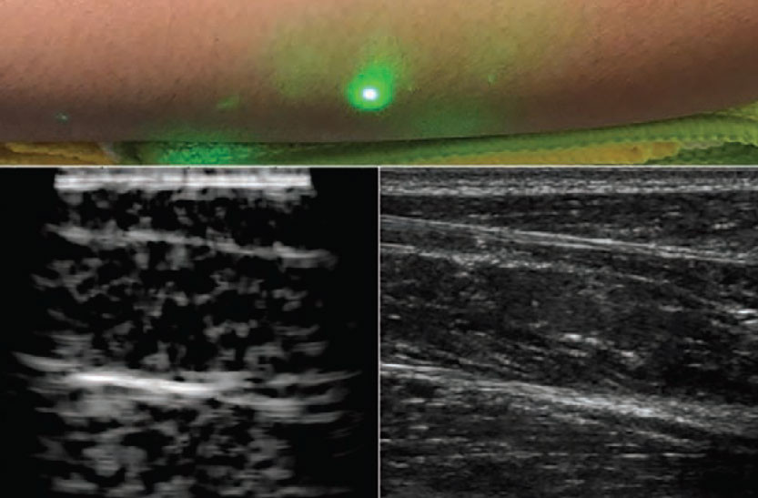 Foto: Imazhi i parë i indit njerëzor duke e përdorur teknikën e re të ultrazërit laserik (majtas) në krahasim me metodën aktuale tradicionale të ultrazërit (djathtas) (Zhang, Anthony et al. Light Sci Appl 8, 119 (2019))