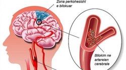 Kolesteroli i ulët mund të rrisë rrezikun e sulmit në tru