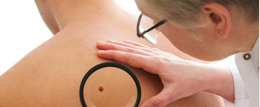 Mos neglizhoni nishanet, melanoma është vdekjeprurëse