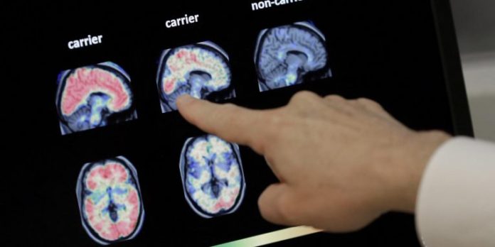 Zbulimi më premtues në trajtimin e Alzheimerit nuk është një ilaç