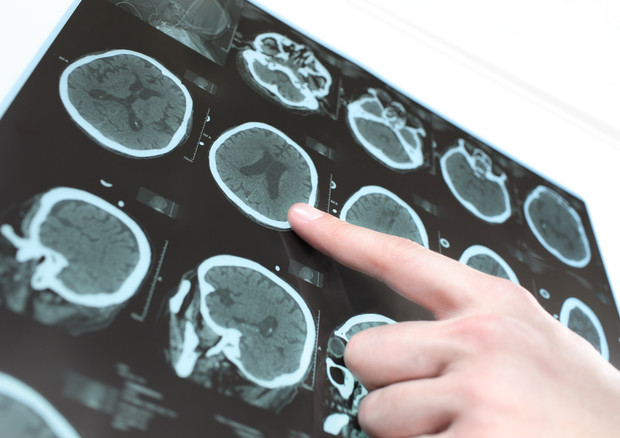 Identifikohen molekulat që mund të ngadalësojnë Parkinsonin