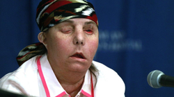 Amerikanja e parë që bëri transplant të fytyrës dy herë brenda dekadës