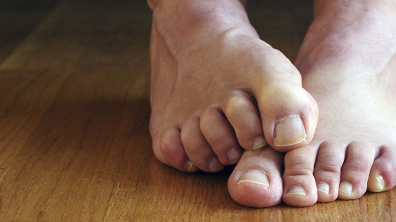 Katër mënyra për të parandaluar djersitjen e këmbëve gjatë verës
