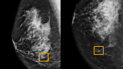 ​Inteligjenca artificiale diagnostikon kancerin e gjirit më shpejt se mjekët