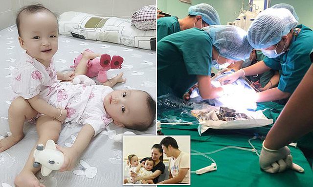 100 doktorë në Vietnam ndajnë me sukses pas 12 orësh binjaket e ngjitura