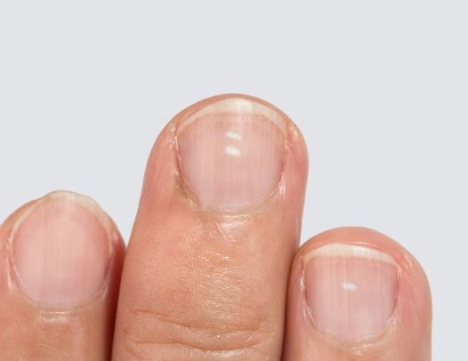 What these common nail problems could be telling you about your health -  HelloGigglesHelloGiggles