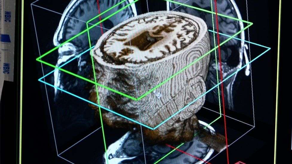 Inteligjenca artificiale mund ta diagnostikojë demencën për një ditë