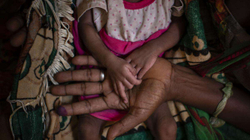 Rreth 33,000 fëmijë në Etiopi rrezikojnë të vdesin nga uria