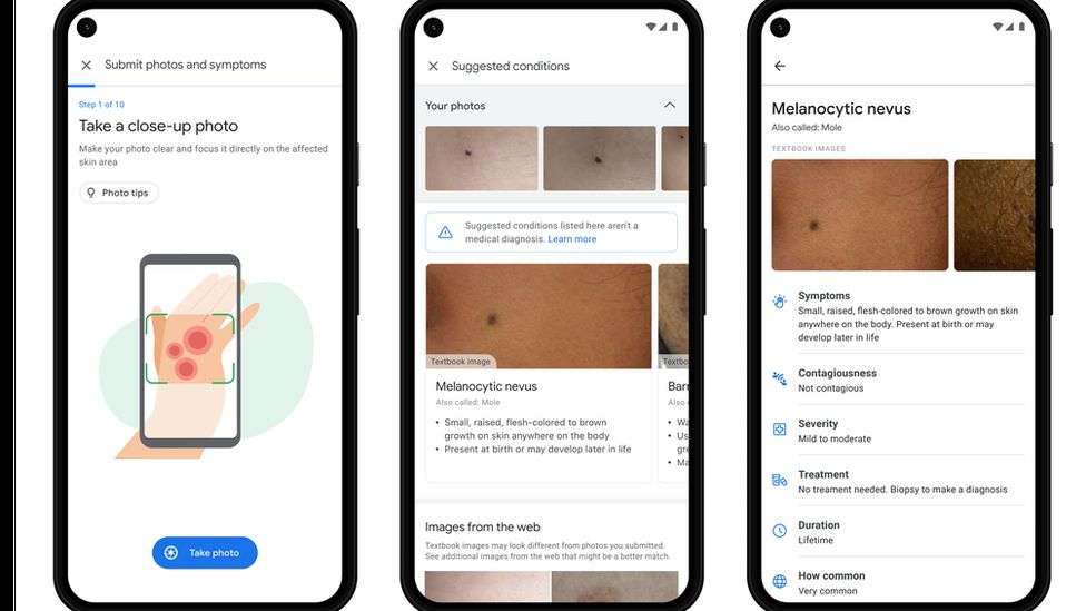 Google prezanton një aplikacion që ndihmon pacientët të identifikojnë problemet në lëkurë