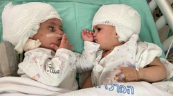 Kryhet një operacion i rrallë në Izrael, ndahen dy binjakë të ngjitur në kokë