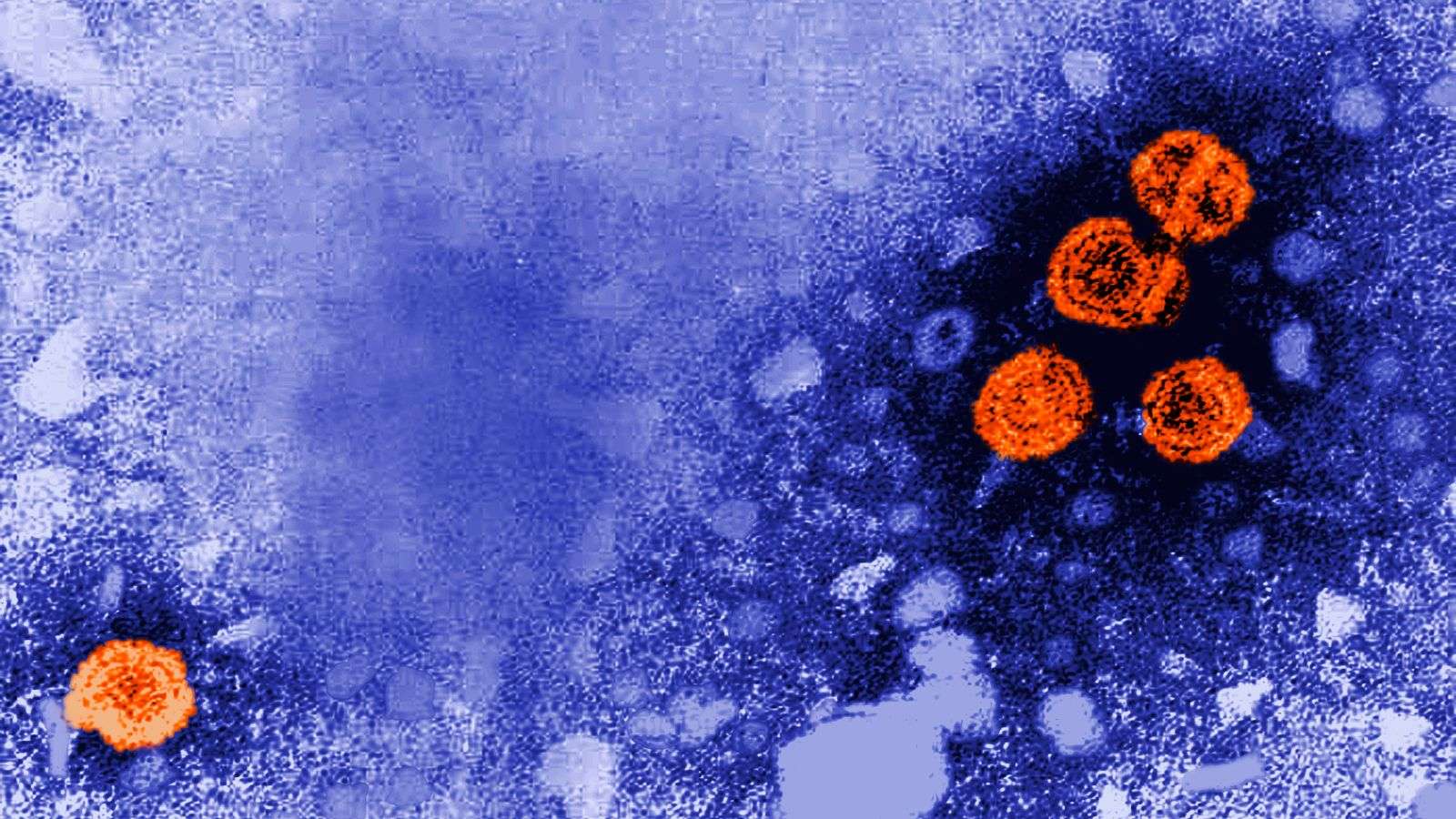 Hepatiti i mistershëm te fëmijët shpërndahet në 12 vende