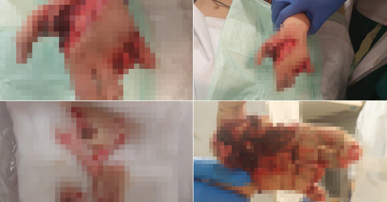 I shpërtheu fishekzjarri në duar, 9-vjeçari kroat humb katër gishta