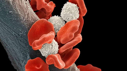 Gruaja e parë në botë shërohet nga HIV falë terapisë me qeliza burimore