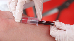Një mënyrë e re për të diagnostikuar kancerin, test i lirë dhe i shpejtë