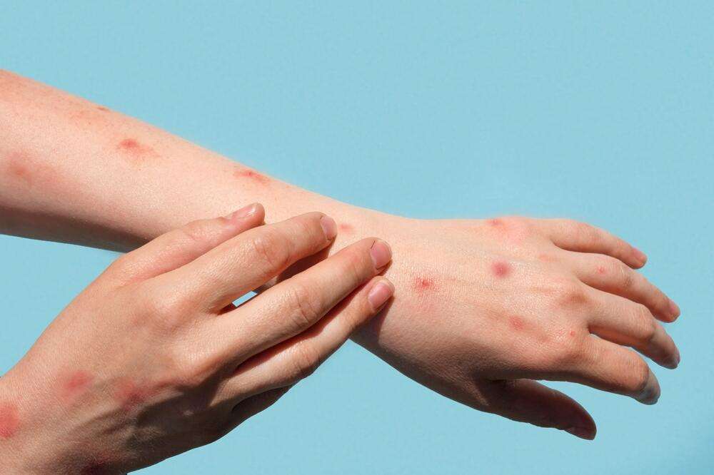 Konfirmohet rasti i parë i lisë së majmunëve në Mal të Zi