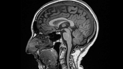 Skanimet zbulojnë ndikimin e Covid-19 në trurin e njeriut