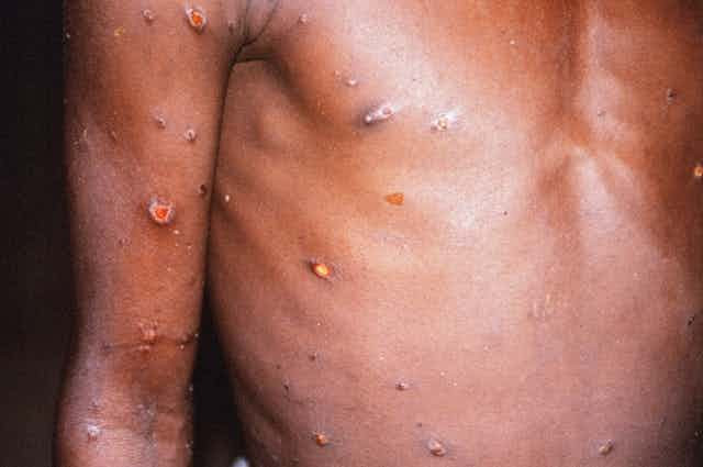 Lija e Majmunit - Monkeypox