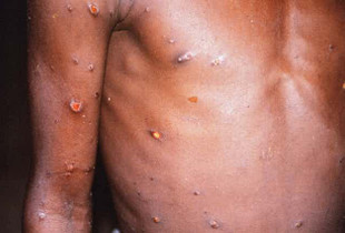 Lija e Majmunit - Monkeypox