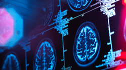 Epokë e re në mjekësi, jepen sinjale pozitive për luftimin e Alzheimerit