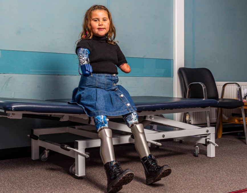 Tetëvjeçares nga Britania i vendosen gjunjët robotikë, bëhet personi më i ri me proteza të tilla