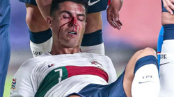 Ronaldo gjakoset pas përplasjes me portierin çek