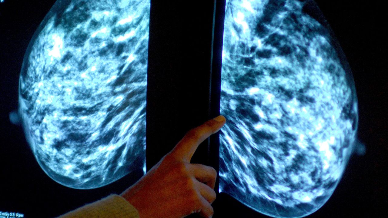 Të diagnostikuarit me kancer të gjirit vlerësohet se po mbingarkohen me trajtim të panevojshëm