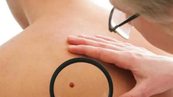 Melanoma, 10 mite dhe të vërteta për kancerin e lëkurës