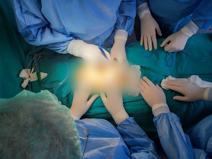 Për 9 muaj në Urologji u realizuan 811 raste të thyerjes së gurëve në veshkë