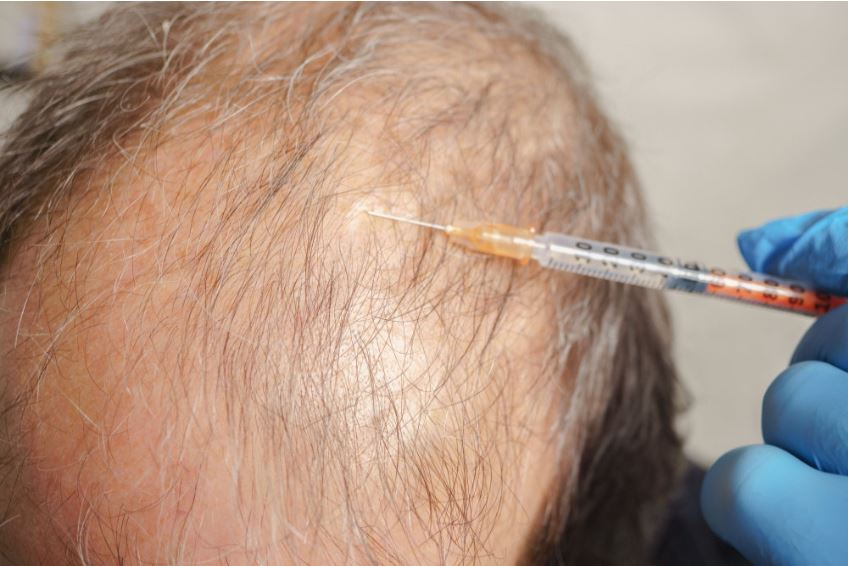 Studie: Fettinjektion am Kopf kann Haarausfall stoppen 