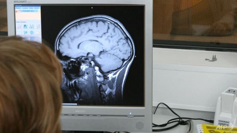 Rusja po jeton qe 80 vjet me një gjilpërë 3-centimetërshe në tru, arsyeja është tronditëse