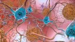Shkencëtarët zbulojnë arsyen e vdekjes së qelizave të trurit gjatë Alzheimerit”