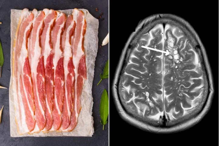 Efeketi i mishit të papjekur të derrit