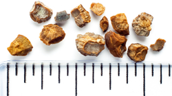 How to understand if you have kidney stones - what to do