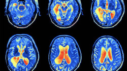 Wie wirkt sich ein hoher Cholesterinspiegel auf die Gehirnalterung aus?