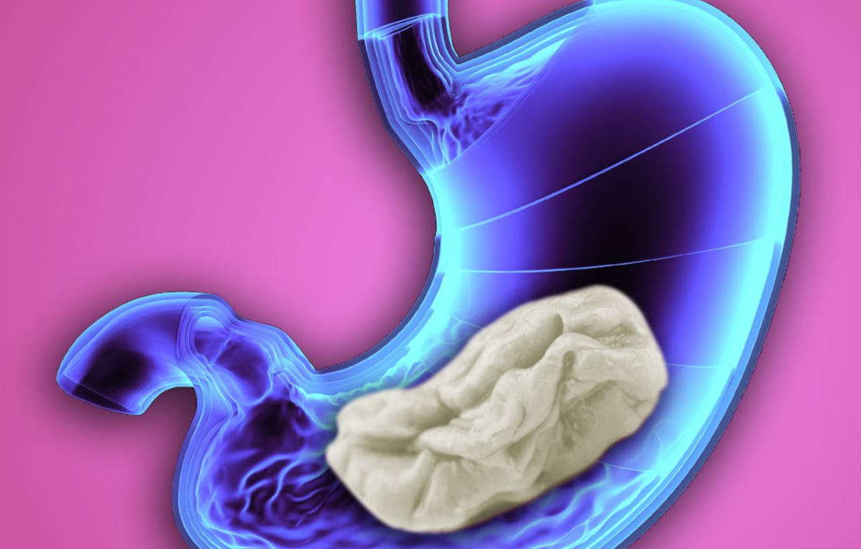 Experten raten: Kaugummi niemals schlucken - KOHA.net