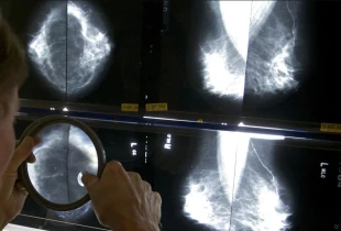 Revista Cancer, ka sjellë analizën më të gjerë deri tani mbi ndikimin e pandemisë në të dhënat e kancerit në SHBA