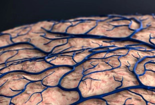 Alzheimer