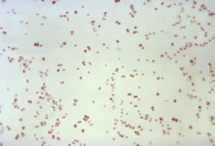 Gonorrea dhe bakteret MRSA