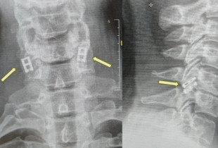 Palca kurrizore - implant