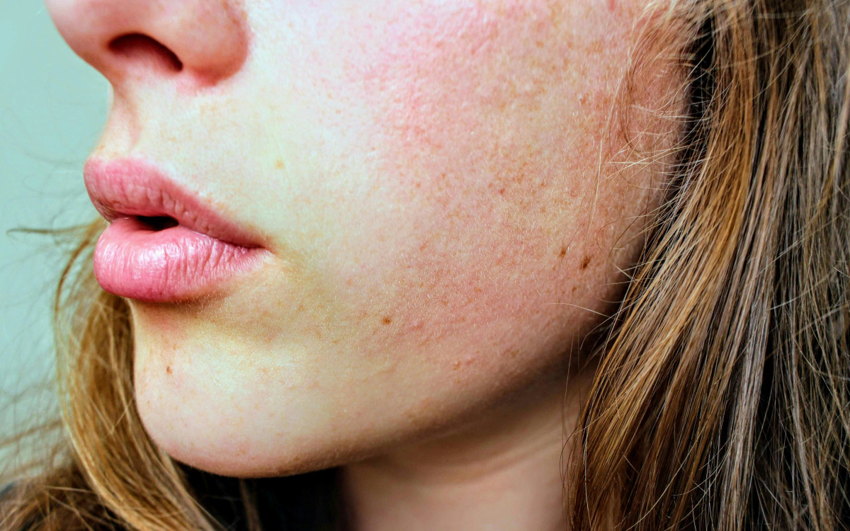 arsyet-pse-fytyra-skuqet-me-shume-teksa-plakeni-kur-vuani-nga-rosacea