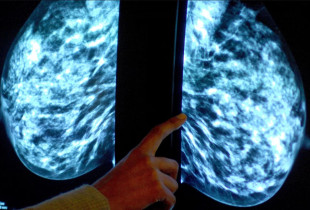 Kanceri i gjirit diagnostikohet më lehtë përmes AI-së
