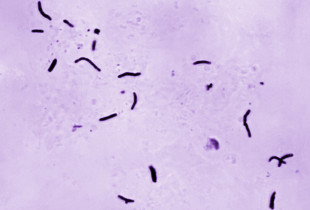 Tuberkulozi