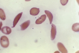 Anemia