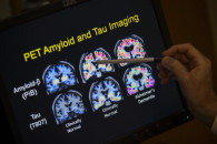 Alzheimer