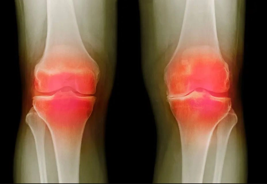 Fotografi me rreze X e një pacienti 66 vjeç me osteoartit, nga doktori P.Marazzi